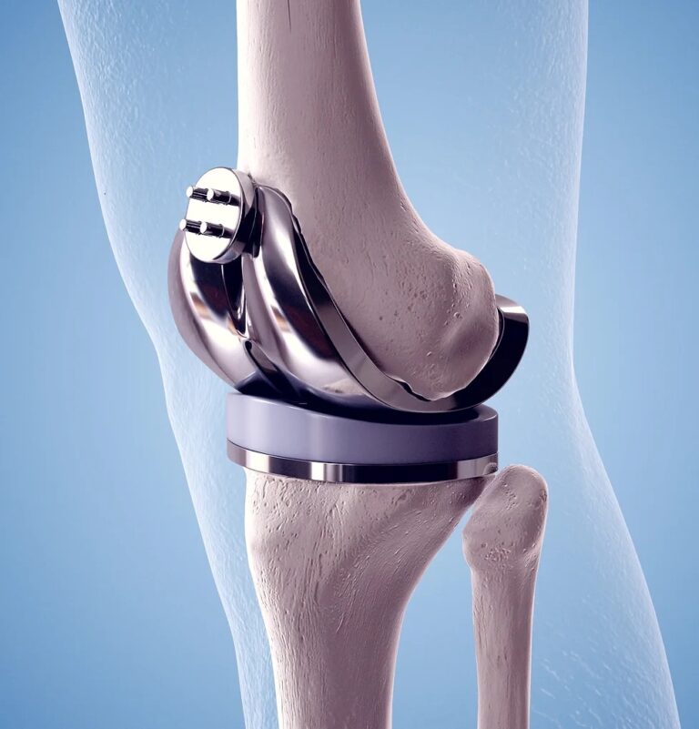 Centurion Orthopaedic Centre How will my knee feel after a TKR? Centurion Orthopaedic Centre