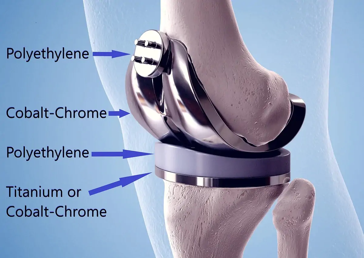 Knee Replacement Materials