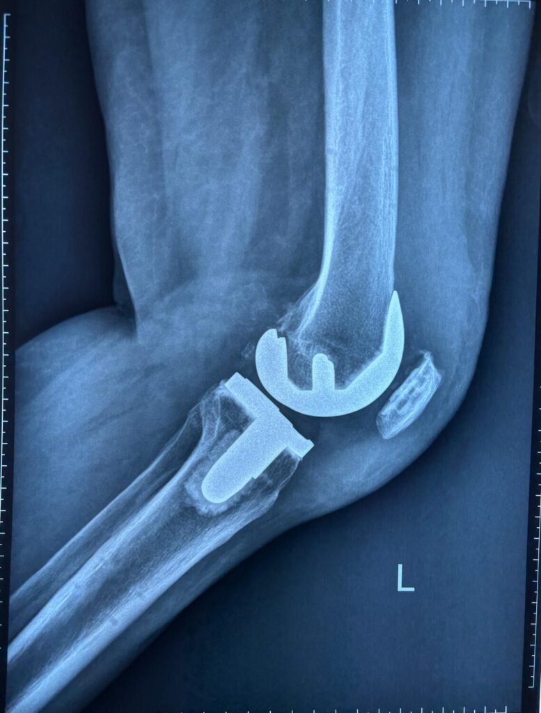 Centurion Orthopaedic Centre Robotic Assisted Surgery Centurion