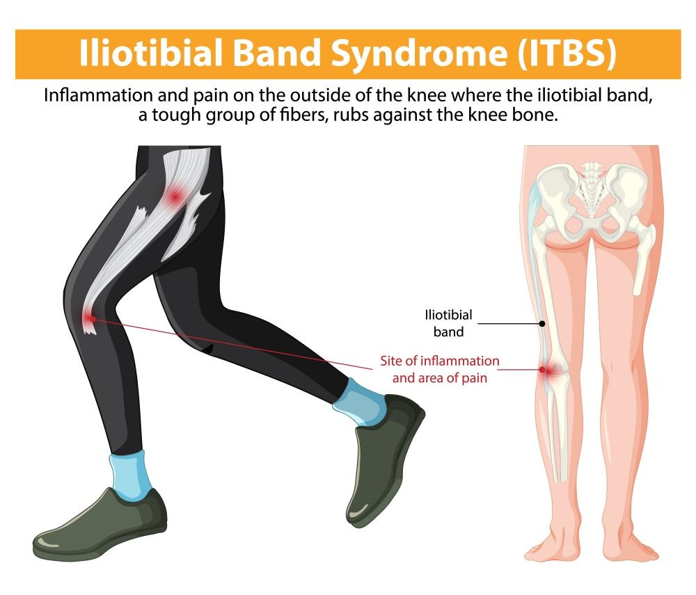 iliotibial band syndrome itbs