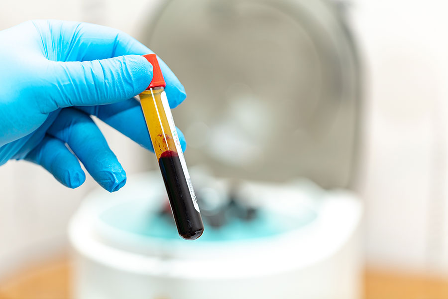 Platelet-rich plasma sample prepared for a PRP knee injection in Singapore - Centurion Orthopaedic Centre