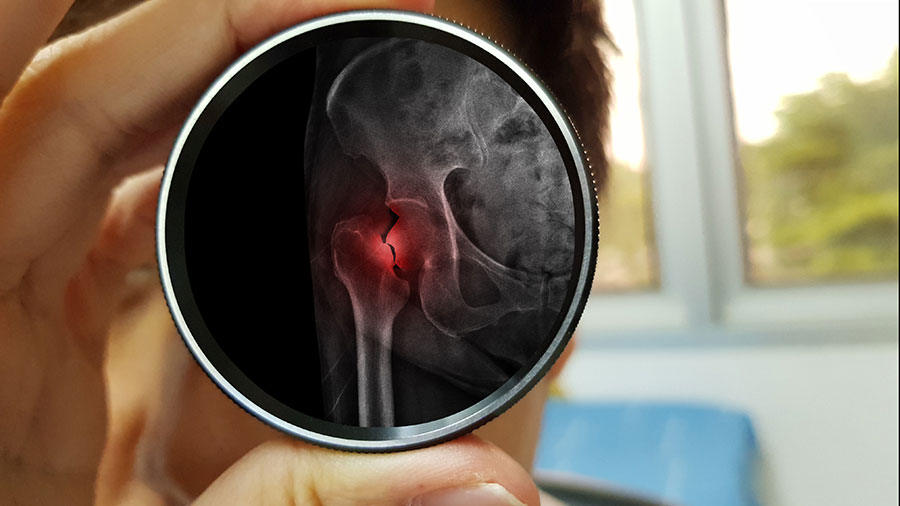 X-ray showing a fractured hip, highlighting the importance of early osteoporosis screening and fracture prevention in Singapore - Centurion Orthopaedic Centre